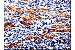 The image on the left is immunohistochemistry of paraffin-embedded Human stomach cancer tissue using CSB-PA181186(ACSBG2 Antibody) at dilution 1/60, on the right is treated with fusion protein. (Original magnification: 