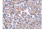 The image on the left is immunohistochemistry of paraffin-embedded Human thyroid cancer tissue using CSB-PA181246(DUSP22 Antibody) at dilution 1/60, on the right is treated with fusion protein. (Original magnification: 
