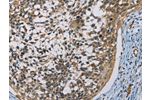 The image on the left is immunohistochemistry of paraffin-embedded Human cervical cancer tissue using CSB-PA181338(CSNK1E Antibody) at dilution 1/60, on the right is treated with fusion protein. (Original magnification: 