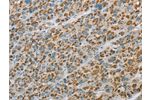 The image on the left is immunohistochemistry of paraffin-embedded Human liver cancer tissue using CSB-PA181544(EHHADH Antibody) at dilution 1/20, on the right is treated with fusion protein. (Original magnification: 