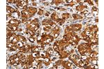 The image on the left is immunohistochemistry of paraffin-embedded Human breast cancer tissue using CSB-PA181894(GGCX Antibody) at dilution 1/60, on the right is treated with fusion protein. (Original magnification: 