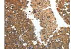 The image on the left is immunohistochemistry of paraffin-embedded Human breast cancer tissue using CSB-PA181901(CRP Antibody) at dilution 1/80, on the right is treated with fusion protein. (Original magnification: 