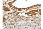 The image on the left is immunohistochemistry of paraffin-embedded Human colon cancer tissue using CSB-PA182143(COL1A2 Antibody) at dilution 1/70, on the right is treated with fusion protein. (Original magnification: 