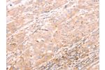 The image on the left is immunohistochemistry of paraffin-embedded Human esophagus cancer tissue using CSB-PA182593(ALPPL2 Antibody) at dilution 1/20, on the right is treated with synthetic peptide. (Original magnification: 