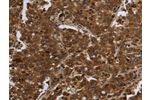 The image on the left is immunohistochemistry of paraffin-embedded Human liver cancer tissue using CSB-PA182654(FASTKD1 Antibody) at dilution 1/60, on the right is treated with fusion protein. (Original magnification: 