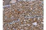 The image on the left is immunohistochemistry of paraffin-embedded Human thyroid cancer tissue using CSB-PA182700(NUCB2 Antibody) at dilution 1/40, on the right is treated with synthetic peptide. (Original magnification: 