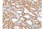 The image on the left is immunohistochemistry of paraffin-embedded Human thyroid cancer tissue using CSB-PA182772(ACSBG1 Antibody) at dilution 1/25, on the right is treated with fusion protein. (Original magnification: 