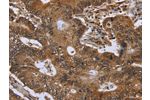 The image on the left is immunohistochemistry of paraffin-embedded Human colon cancer tissue using CSB-PA182810(FHIT Antibody) at dilution 1/30, on the right is treated with fusion protein. (Original magnification: 