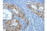 The image on the left is immunohistochemistry of paraffin-embedded Human cervical cancer tissue using CSB-PA182867(FSCN1 Antibody) at dilution 1/20, on the right is treated with fusion protein. (Original magnification: 