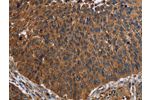 The image on the left is immunohistochemistry of paraffin-embedded Human lung cancer tissue using CSB-PA183080(FCGR3A Antibody) at dilution 1/60, on the right is treated with fusion protein. (Original magnification: 