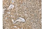 The image on the left is immunohistochemistry of paraffin-embedded Human lung cancer tissue using CSB-PA183145(DNAJB1 Antibody) at dilution 1/40, on the right is treated with fusion protein. (Original magnification: 