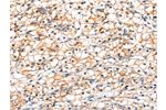 The image on the left is immunohistochemistry of paraffin-embedded Human renal cancer tissue using CSB-PA183226(GLP1R Antibody) at dilution 1/20, on the right is treated with fusion protein. (Original magnification: 