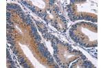 The image on the left is immunohistochemistry of paraffin-embedded Human colon cancer tissue using CSB-PA183273(CD48 Antibody) at dilution 1/40, on the right is treated with synthetic peptide. (Original magnification: 