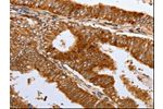The image on the left is immunohistochemistry of paraffin-embedded Human cervical cancer tissue using CSB-PA183398(DNMT1 Antibody) at dilution 1/12, on the right is treated with synthetic peptide. (Original magnification: 