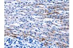 The image on the left is immunohistochemistry of paraffin-embedded Human liver cancer tissue using CSB-PA183460(FOXJ1  Antibody) at dilution 1/20, on the right is treated with synthetic peptide. (Original magnification: 