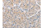 The image on the left is immunohistochemistry of paraffin-embedded Human liver cancer tissue using CSB-PA183796(ARHGEF9 Antibody) at dilution 1/50, on the right is treated with fusion protein. (Original magnification: 