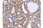 The image on the left is immunohistochemistry of paraffin-embedded Human thyroid cancer tissue using CSB-PA183839(GFER Antibody) at dilution 1/50, on the right is treated with fusion protein. (Original magnification: 