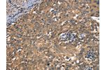 The image on the left is immunohistochemistry of paraffin-embedded Human cervical cancer tissue using CSB-PA184126(DAAM1 Antibody) at dilution 1/50, on the right is treated with synthetic peptide. (Original magnification: 