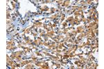 The image on the left is immunohistochemistry of paraffin-embedded Human thyroid cancer tissue using CSB-PA184322(CD244 Antibody) at dilution 1/50, on the right is treated with fusion protein. (Original magnification: 