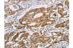 The image on the left is immunohistochemistry of paraffin-embedded Human gastic cancer tissue using CSB-PA184759(DMRT3 Antibody) at dilution 1/25, on the right is treated with fusion protein. (Original magnification: 