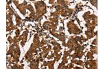 The image on the left is immunohistochemistry of paraffin-embedded Human breast cancer tissue using CSB-PA185232(ATRN Antibody) at dilution 1/50, on the right is treated with synthetic peptide. (Original magnification: 