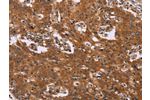 The image on the left is immunohistochemistry of paraffin-embedded Human gastric cancer tissue using CSB-PA185437(CMTM6 Antibody) at dilution 1/40, on the right is treated with synthetic peptide. (Original magnification: 