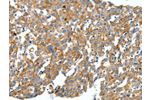 The image on the left is immunohistochemistry of paraffin-embedded Human breast cancer tissue using CSB-PA185715(CXCL12 Antibody) at dilution 1/40, on the right is treated with synthetic peptide. (Original magnification: 