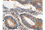 The image on the left is immunohistochemistry of paraffin-embedded Human colon cancer tissue using CSB-PA185779(FAS Antibody) at dilution 1/60, on the right is treated with fusion protein. (Original magnification: 