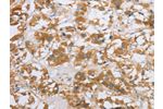 The image on the left is immunohistochemistry of paraffin-embedded Human thyroid cancer tissue using CSB-PA186108(CYP2E1 Antibody) at dilution 1/35, on the right is treated with fusion protein. (Original magnification: 