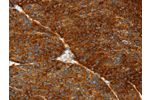 The image on the left is immunohistochemistry of paraffin-embedded Human liver cancer tissue using CSB-PA186229(ASGR1 Antibody) at dilution 1/50, on the right is treated with fusion protein. (Original magnification: 