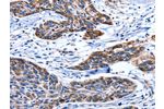 The image on the left is immunohistochemistry of paraffin-embedded Human esophagus cancer tissue using CSB-PA186529(AQP8 Antibody) at dilution 1/75, on the right is treated with synthetic peptide. (Original magnification: 
