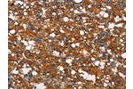 The image on the left is immunohistochemistry of paraffin-embedded Human thyroid cancer tissue using CSB-PA186754(COX5A Antibody) at dilution 1/40, on the right is treated with synthetic peptide. (Original magnification: 