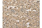 The image on the left is immunohistochemistry of paraffin-embedded Human thyroid cancer tissue using CSB-PA186785(ALDH8A1 Antibody) at dilution 1/30, on the right is treated with fusion protein. (Original magnification: 