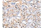 The image on the left is immunohistochemistry of paraffin-embedded Human thyroid cancer tissue using CSB-PA186887(CEP97 Antibody) at dilution 1/25, on the right is treated with fusion protein. (Original magnification: 