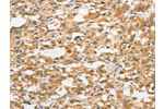 The image on the left is immunohistochemistry of paraffin-embedded Human thyroid cancer tissue using CSB-PA187039(ANAPC5 Antibody) at dilution 1/30, on the right is treated with fusion protein. (Original magnification: 