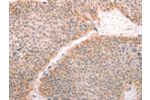 The image on the left is immunohistochemistry of paraffin-embedded Human thyroid cancer tissue using CSB-PA187767(ABHD12 Antibody) at dilution 1/30, on the right is treated with fusion protein. (Original magnification: 