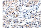 The image on the left is immunohistochemistry of paraffin-embedded Human lung cancer tissue using CSB-PA188267(FBLN5 Antibody) at dilution 1/85, on the right is treated with synthetic peptide. (Original magnification: 
