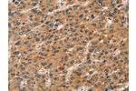 The image on the left is immunohistochemistry of paraffin-embedded Human liver cancer tissue using CSB-PA188638(CXCR6 Antibody) at dilution 1/20, on the right is treated with fusion protein. (Original magnification: 