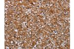 The image on the left is immunohistochemistry of paraffin-embedded Human prostate cancer tissue using CSB-PA188650(ATP2A1 Antibody) at dilution 1/35, on the right is treated with synthetic peptide. (Original magnification: 