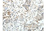 The image on the left is immunohistochemistry of paraffin-embedded Human cervical cancer tissue using CSB-PA188693(FZD3 Antibody) at dilution 1/20, on the right is treated with synthetic peptide. (Original magnification: 