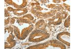The image on the left is immunohistochemistry of paraffin-embedded Human colon cancer tissue using CSB-PA188838(AKR1C1 Antibody) at dilution 1/30, on the right is treated with synthetic peptide. (Original magnification: 