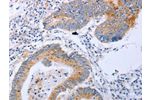 The image on the left is immunohistochemistry of paraffin-embedded Human colon cancer tissue using CSB-PA189054(DNMT3L Antibody) at dilution 1/10, on the right is treated with fusion protein. (Original magnification: 