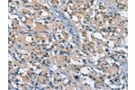 The image on the left is immunohistochemistry of paraffin-embedded Human thyroid cancer tissue using CSB-PA189397(GAS2 Antibody) at dilution 1/50, on the right is treated with fusion protein. (Original magnification: 
