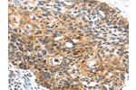 The image on the left is immunohistochemistry of paraffin-embedded Human esophagus cancer tissue using CSB-PA189699(CENPM Antibody) at dilution 1/30, on the right is treated with fusion protein. (Original magnification: 