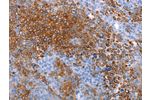 The image on the left is immunohistochemistry of paraffin-embedded Human ovarian cancer tissue using CSB-PA191314(AQP5 Antibody) at dilution 1/20, on the right is treated with synthetic peptide. (Original magnification: 