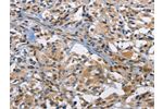 The image on the left is immunohistochemistry of paraffin-embedded Human thyroid cancer tissue using CSB-PA191502(FOS Antibody) at dilution 1/70, on the right is treated with fusion protein. (Original magnification: 