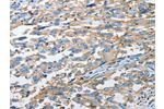 The image on the left is immunohistochemistry of paraffin-embedded Human esophagus cancer tissue using CSB-PA191560(CD44 Antibody) at dilution 1/25, on the right is treated with synthetic peptide. (Original magnification: 