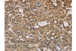 The image on the left is immunohistochemistry of paraffin-embedded Human thyroid cancer tissue using CSB-PA191736(DEGS1 Antibody) at dilution 1/30, on the right is treated with fusion protein. (Original magnification: 