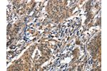 The image on the left is immunohistochemistry of paraffin-embedded Human gastic cancer tissue using CSB-PA192309(ALOX15 Antibody) at dilution 1/50, on the right is treated with synthetic peptide. (Original magnification: 