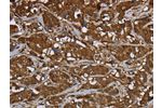 The image on the left is immunohistochemistry of paraffin-embedded Human breast cancer tissue using CSB-PA192321(ARHGDIA Antibody) at dilution 1/50, on the right is treated with fusion protein. (Original magnification: 